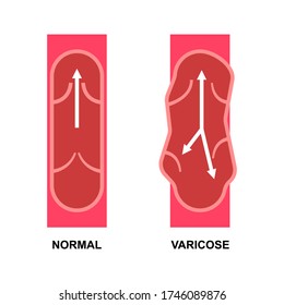 Vector varicose vein and normal vein on white. Stock vector icon