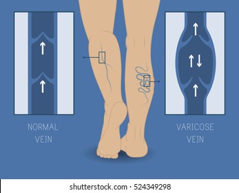 Vector Varicose Vein And Normal Vein. Slender And Beautiful Female Legs. Varicose Vein.