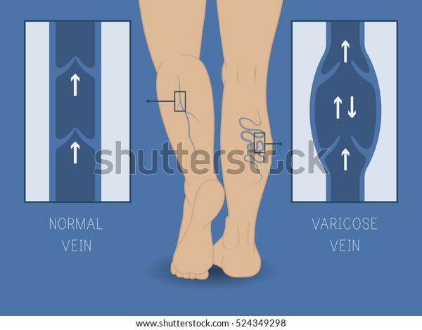 Vector Varicose Vein Normal Vein Slender Stock Vector (Royalty Free ...