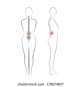 Vector woman body shape. Vertebrae pain.