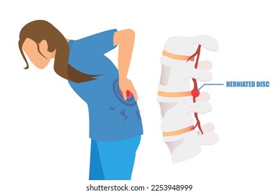 Vector of a young woman with a low back pain and sciatica from a herniated disc. 