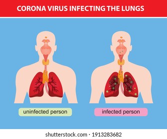Vectorial imaginary representation of the damage caused by the corona virus in the lungs
