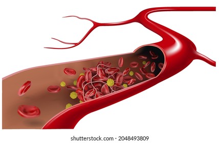 In The Vein, Cholesterol Flows With Erythrocytes And Form A Blood Clot. 3d Vector Illustration