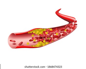 In the vein, cholesterol stops the flow of red blood cells