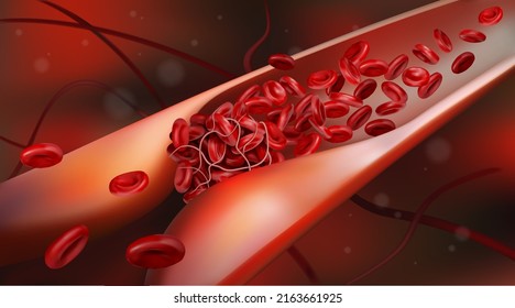 Vein with red blood cell flow and blood clot. 3d vector illustration
