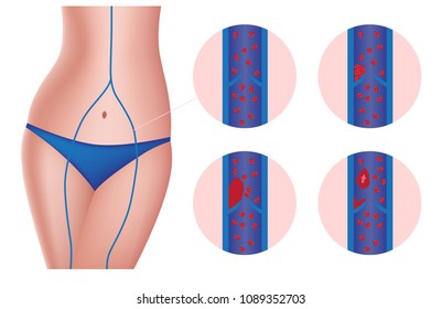 vein thrombosis embolus vector / arteriosclerosis
