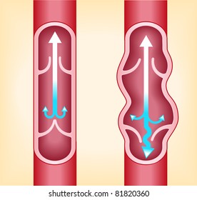 1,382 Varicose veins Stock Vectors, Images & Vector Art | Shutterstock