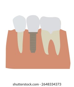  vektor tooth implantation, tooth restoration, Mesh gradient wes. dentures