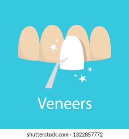 Veneer concept. Idea of tooth restoration and crown installation. Dental care and medical treatment. Isolated vector illustration in cartoon style