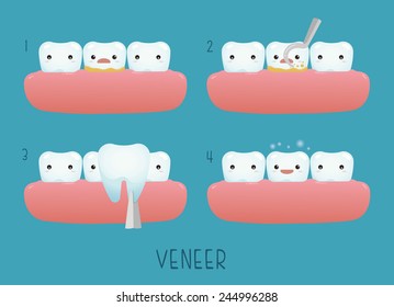 Veneer tooth of dental