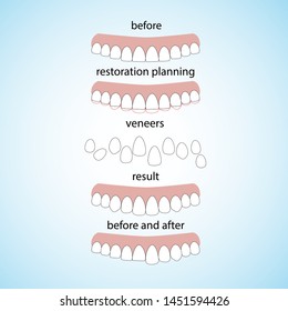 Veneers dentistry, great design for any purposes