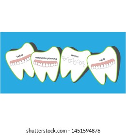 Veneers dentistry, great design for any purposes