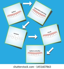 Veneers dentistry, great design for any purposes
