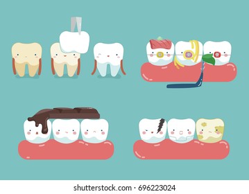 Veneers, food stuck teeth, chocolate on top the teeth and symptom of dental, dental set concept