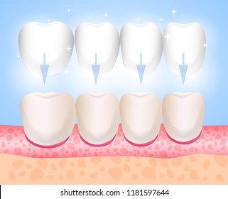 Veneers, Lumineers, onlays, microprosthesis. Installation of veneers. Aesthetic medicine. Direction dentistry orthopedics