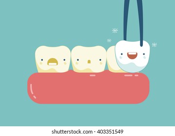 Veneers teeth of dental concept