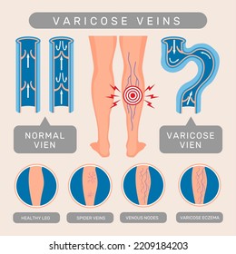 Problemas venosos. Plantilla infográfica de sistemas de esquemas de sangre de enfermedades venosas varicosas ilustraciones de vectores recientes