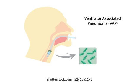 Ilustración de neumonía asociada a ventilación asistida (VAP). Infección en la vía aérea asociada a pacientes intuístes en ventilación mecánica. Secreción por encima del tubo endotraqueal.