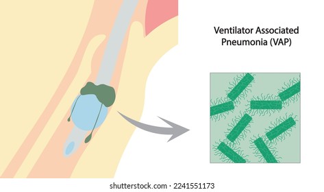Ventilator associated pneumonia (VAP) illustration. Infection in the airway associated with intuístes patient in mechanical ventilation. Secretion above the endotracheal tube cuff.