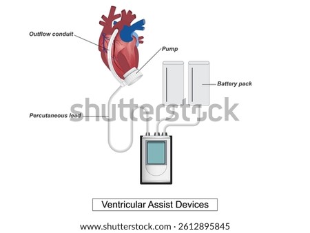 A Ventricular Assist Device (VAD) is a mechanical pump that's used to support heart function and blood flow in people with weakened hearts.Medical health vector illustration.