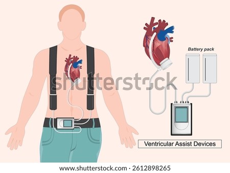 A Ventricular Assist Device (VAD) is a mechanical pump that helps the heart circulate blood throughout the body in patients with severe heart failure. Medical health vector illustration.
