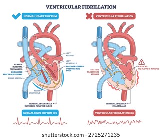 Ventrikuläre Fibrillation erklärt, Seite-an-Seite-Herzdiagramm kontrastiert normalen Rhythmus mit chaotischem Zittern, Schlüsselelemente sind Ventrikel, elektrische Signale und EKG-Spuren. Gliederungsplan