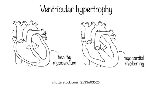 Ventricular hypertrophy. An increase in the thickness of the heart wall, which develops under conditions of chronic overload of the heart. Healthy heart and heart with myocardial hypertrophy. 