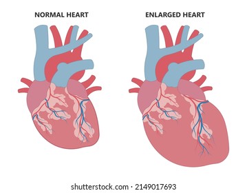 Ventricular Hypertrophy Symptom Heart Failure Medical Stock Vector ...