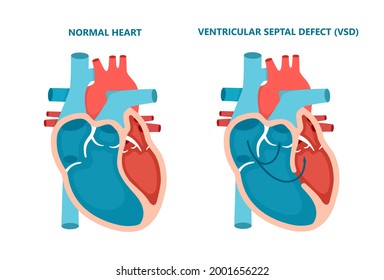 364 Ventricular atrium Images, Stock Photos & Vectors | Shutterstock