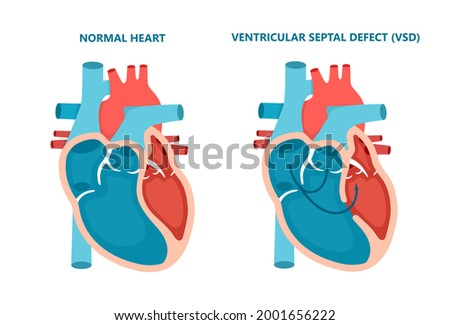 Ventricular septal defect VSD. Human heart muscle diseases cross-section. Cardiology concept.