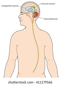 Ventriculoperitoneal Shunt To Drain Excess CSF From The Brain In Cases Of Hydrocephalus