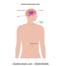 Ventriculoperitoneal shunt. Ventricular system anatomy, communicating cavities within the brain. Cerebral ventricles, production, transport and removal of cerebrospinal fluid flat vector illustration