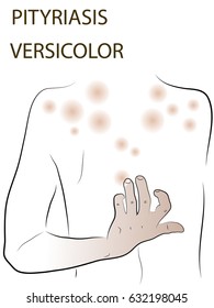 versicolor. The woman on her back has a colorful lichen. Colored vector illustration of a skin lesion.