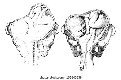 Version in the second position of the left shoulder, Introduction of the hand and foot entry. Second position of the right shoulder. Entering feet. Usual Medicine Dictionary by Dr Labarthe - 1885.