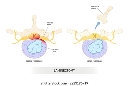 vertebrae back pain lumbar of diskectomy laminectomy spine cord surgery root disc tumor cancer cyst bone spurs Muscle weakness transforaminal compressed annular tear nerve Anterior fusion replacement