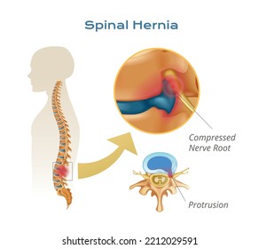 Vertebrae Spinal Cord Anatomy Infographics With Body Silhouette With Spine And Compressed Nerve Root Protrusion Views Vector Illustration