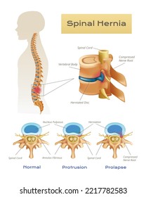 Vertebrae spinal cord anatomy infographics with scientific view of spinal hernia with text captions and pointers vector illustration