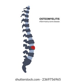 Vertebral osteomyelitis. Infected spine bones, sequestrum and pain. Infection spreads through the bloodstream into the backbone. Consultation with doctor in clinic, medical flat vector illustration