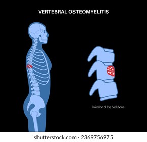 Osteomielitis vertebral. Hueso de columna infectada, secuestro y dolor. La infección se extiende a través del torrente sanguíneo hasta la columna vertebral. Consulta con el médico en la clínica, ilustración médica plana vectorial