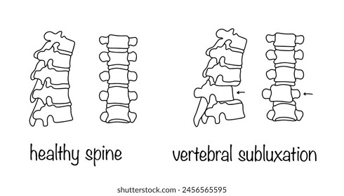 Vertebral subluxation. Partial displacement of a vertebra in the intervertebral joint. Healthy spine and spine with a problem. Simple medical illustration on a white background.