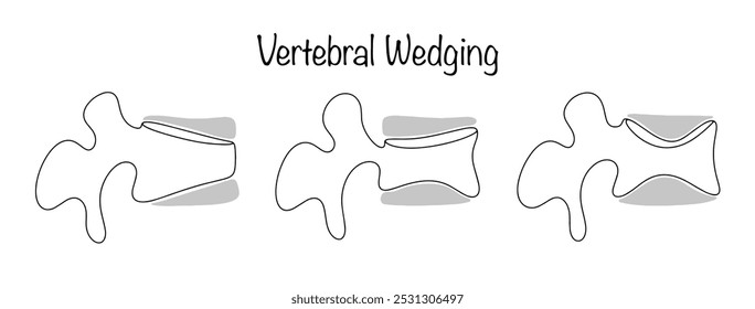 Cuña vertebral. Una anomalía del desarrollo de la columna vertebral, en la que las vértebras están medio subdesarrolladas y tienen un aspecto característico. Vértebras humanas deformadas dibujadas. Vector.