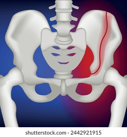 Vertical fracture of the pelvic bone. 3d rendering on a blue background. Medina vector illustration