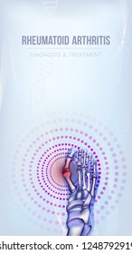 Vertical light blue banner with rheumatoid artritic sore joints concept. Realistic bones of foot skeleton of human leg. For advertising, medical publications in social media. Vector illustration stock