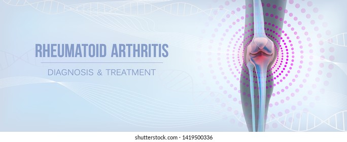 Vertical light rheumatoid arthritis Bones the of knee