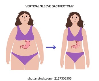 Vertical sleeve gastrectomy anatomical poster. Before and after laparoscopy. Stomach surgery, weight loss gastric procedure. Overweight problem in human body. Isolated flat vector medical illustration