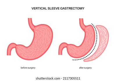 149 Stomach stapling Images, Stock Photos & Vectors | Shutterstock