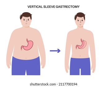 Vertikal Ärmel Magrectomie anatomisches Poster. Vor und nach der Laparoskopie. Magenoperation, Gewichtsverlust Magenoperation. Übergewichtsstörung im menschlichen Körper. Einzelne flache Vektorgrafik