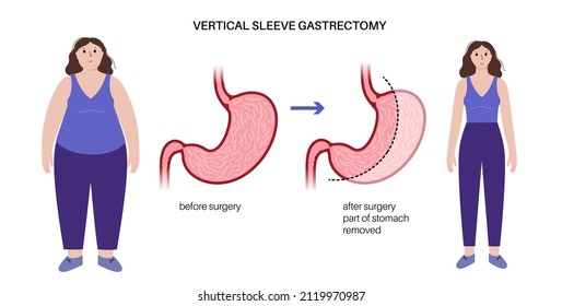 Vertikal Ärmel Magrectomie anatomisches Poster. Vor und nach der Laparoskopie. Magenoperation, Gewichtsverlust Magenoperation. Übergewichtsstörung im menschlichen Körper. Einzelne flache Vektorgrafik