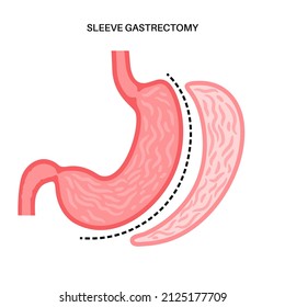 Vertical sleeve gastrectomy anatomical poster. Stomach surgery, weight loss gastric procedure. Laparoscopy concept. Overweight problem in human body. Flat vector medical illustration for clinic