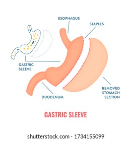 Vertical sleeve gastrectomy. Bariatric surgery weight loss procedure. Stomach reduction anatomical diagram infographic. Health care  medical concept. Vector illustration.